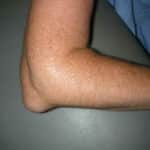 Famous Athlete With Bursitis (LEAKED)